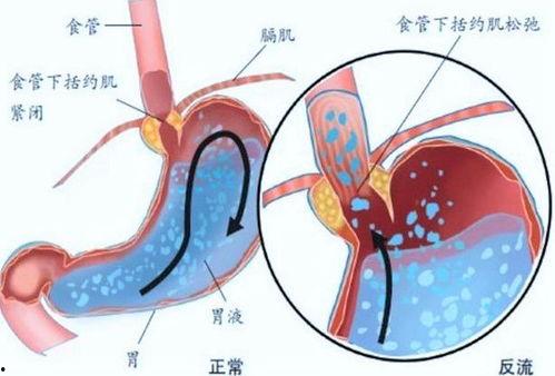 吃甜的瓜辣的胃食道反酸